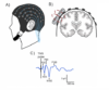 (A) EEG cap; (B) Transcranial magnetic stimulation (TMS) applied to the cortex; (C) electrophysiological tracings from the cortex in response to TMS.